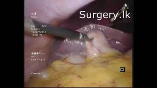 Laparoscopic Cholecystectomy (ලැපරොස්කොපි ක්‍රමයට පිත්තාශය ඉවත්කිරීමෙ ශල්‍යකර්මය)