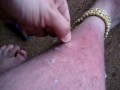 peeling apart my sunburnt legs leg 1