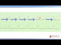 kardioblog ekg kazuistika bradykardie s nepravidelnou srdeční akcí