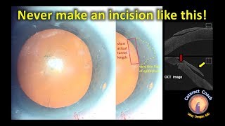 Never make your cataract surgery incision like this!