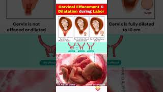 Effacement vs Dilation Explained | Cervical Changes Before Delivery