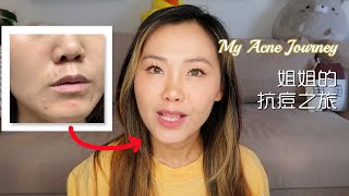 40岁姐姐抗痘经历 祛痘药膏选择 阿达帕林使用 祛痘针|How to treat adult acne, Differin Gel injection acne cream【Eng/Chi Subs】