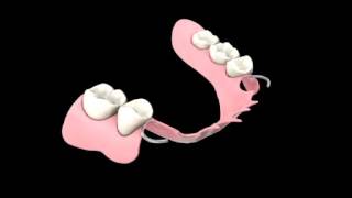 Temporary Partial Denture