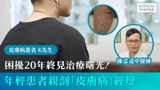 【病人故事】困擾20年終見治療曙光！年輕患者親剖「皮膚病」經歷