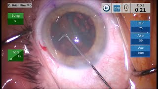 The Best Way To Do Cataract Surgery #5: Rehydrodissect The Stubborn Lens