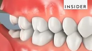 Why Do We Remove Wisdom Teeth?