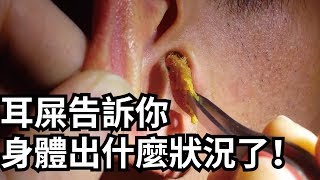 9種顏色不同的耳屎，告訴你身體出什麼狀況了！【大腦衝擊喵大解構】