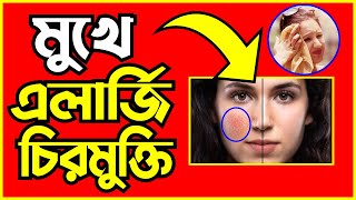 মুখে এলার্জি চুলকানি দূর করার উপায় | মুখে এলার্জি দূর করার ক্রিম