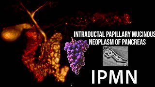 IPMN of pancreas lets diagnose them confidently