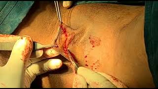 Labiaplasty | Labia minora reduction | cosmetic surgery Bangladesh | Dr Iqbal Ahmed