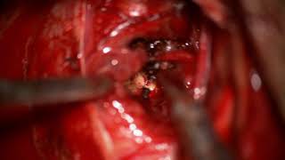 Cavernoma/ Mini pterional craniotomy/ transsylvian approach