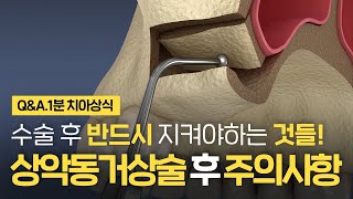 상악동거상술 수술 후 이것 모르면 실패한다고?! 상악동임플란트 주의사항 ⏰1분 치아상식