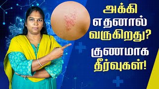 அக்கி நோய் வர காரணங்கள் என்ன? அதற்கான தீர்வுகள் | Shinglest | Herpes zoster | Home Remedies