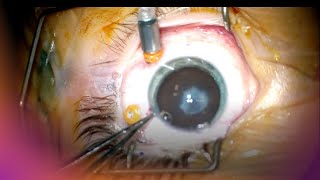 Pediatric Cataract Removal,  IOL insertion, Capsulotomy with History of FEVR Tractional RD