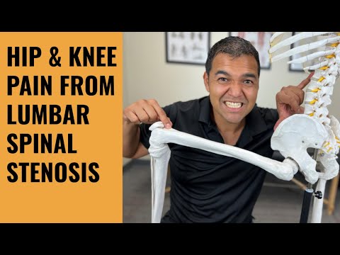 Can spinal stenosis cause hip and knee pain?