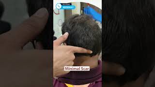 9 Months Result ! Hair Transplant Before After | Divine Cosmetic Surgery #viral