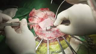 Video Operasi - Suturectomy #1