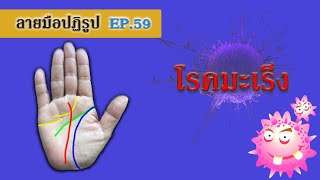 ลายมือปฏิรูป ตอนที่ 59 โรคมะเร็ง