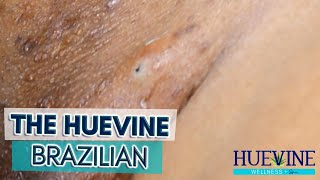 The HueVine Brazilian Skincare Updated Commentary | HueVine Ingrown Hair