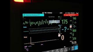 Philips Intellivue MP30 Patient Monitor Alarm Sounds (with ZOLL E Series Defib Intervention)