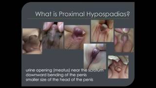 PROXIMAL HYPOSPADIAS Webinar