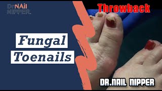 Fungal Toenails: Some Advice [Throwback Thursday]