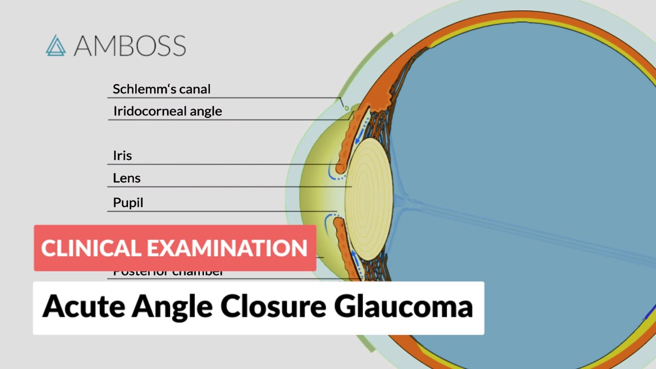 Acute Angle Closure Glaucoma - YouTube