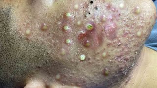 Big Cystic Acne Blackheads Extraction Blackheads \u0026 Milia, Whiteheads Removal Pimple Popping # 1684