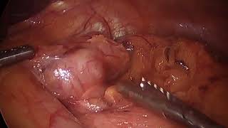 LAPAROSCOPIC PARTIAL GASTRECTOMY FOR INCIDENTAL GIST TUMOR