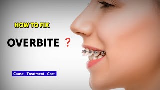 Cost of Overbite Correction Surgery in India? | Dr Parit Ladani