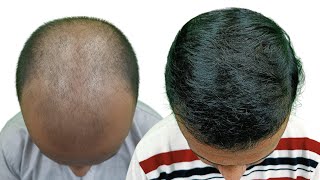 Hair Transplant Results | 5200 Grafts | Best Hair Transplant In Kolkata |
