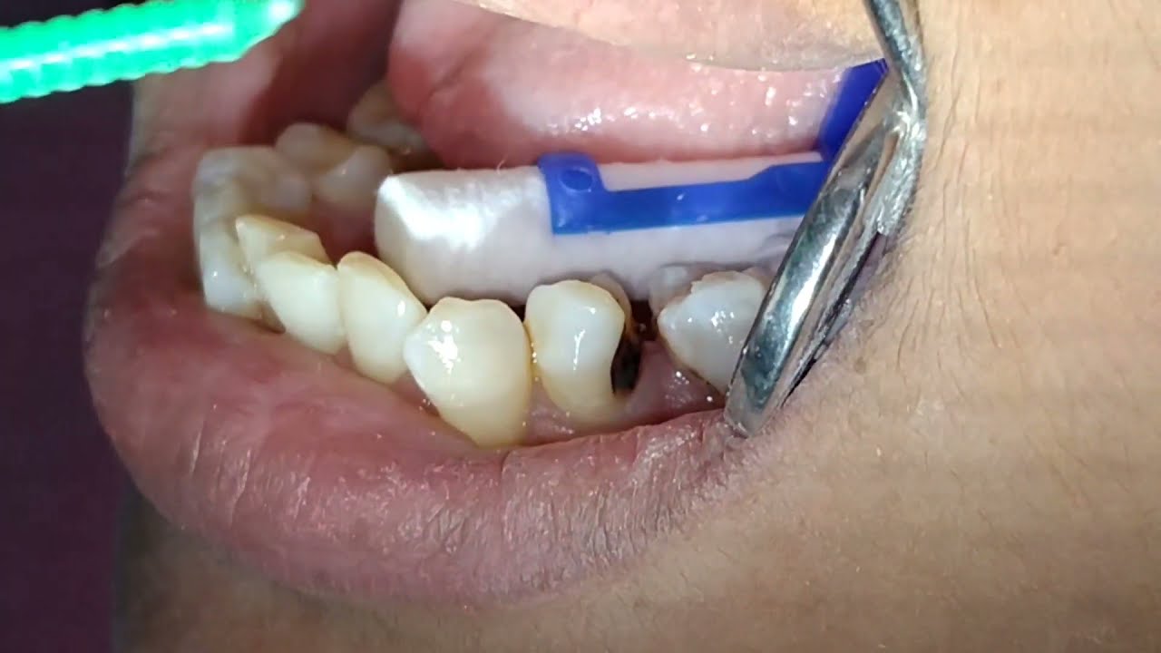 Tambal Gigi Berlubang Sela Gigi | Tooth Filling | Decay | Dentist ...