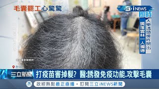 接種後鬼剃頭?! 30歲帥男打完BNT11天 大量掉髮後腦出現\