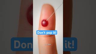 Dont Pop That Blood Blister