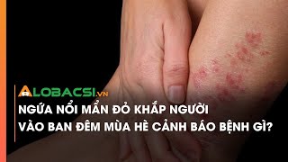 Ngứa nổi mẩn đỏ khắp người vào ban đêm mùa hè cảnh báo bệnh gì?