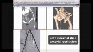 CT of Major Vascular Injury in Blunt Abdominopelvic Trauma