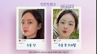 작은얼굴! 날렵한 브이라인! 안면윤곽 3종 #shorts [OPERA Plastic Surgery 오페라성형외과]