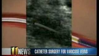Catheter Surgery for Varicose Veins
