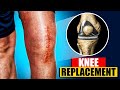 Total Knee Replacement Surgery 3D Animation | 3D Animation of a Knee Replacement | Joint Replacement