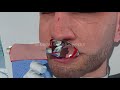 maxilla reconstruction surgery 3d animation