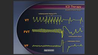 #Pacemaker #ICD #programming \u0026 #troubleshooting #defibrillator #Cardiacdevice #cardiology #CIED