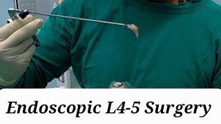 Endoscopic L4-5 Slip Disc Surgery ( Disc prolapse/herniation/ Lumbar disc PIVD operation).