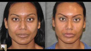 Best Known Acne Treatment - Profound Microneedle Injectable Radiofrequency RF tightening laser