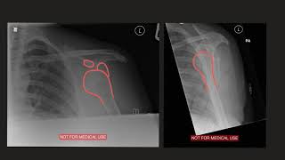 Shoulder dislocation