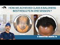 Hair Transplant In Bangalore | Best Surgeon Center & Results Of Hair Transplant In Bangalore