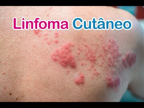 Linfoma Cutâneo - Dr. André Abdo - YouTube