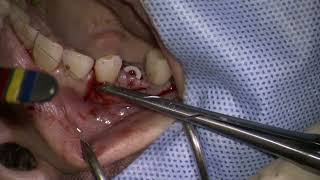 240522 2 piece ceramic implant placement  \u0026 root coverge3