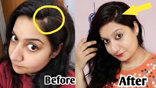 बालों का टूटना,झड़ना,गंजापन सब ठीक करे इस उपाय से/My personal Alopecia(Baldness)Journey/100%Results