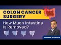 Colon Cancer Surgery Explained: Hemicolectomy, Radical Hemicolectomy, & More | Dr. Ganesh Nagarajan