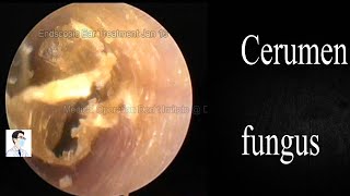 Fungal cleaning and antibacterial treatment of external auditory canal,9mins,20230116